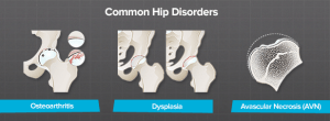 What Disorders Cause Hip Pain? - Brainlab.org