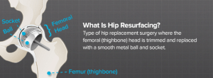 What is Hip Resurfacing? - Brainlab.org