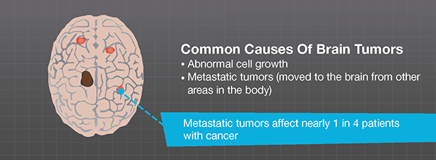 What Causes Brain Tumors Brainlab