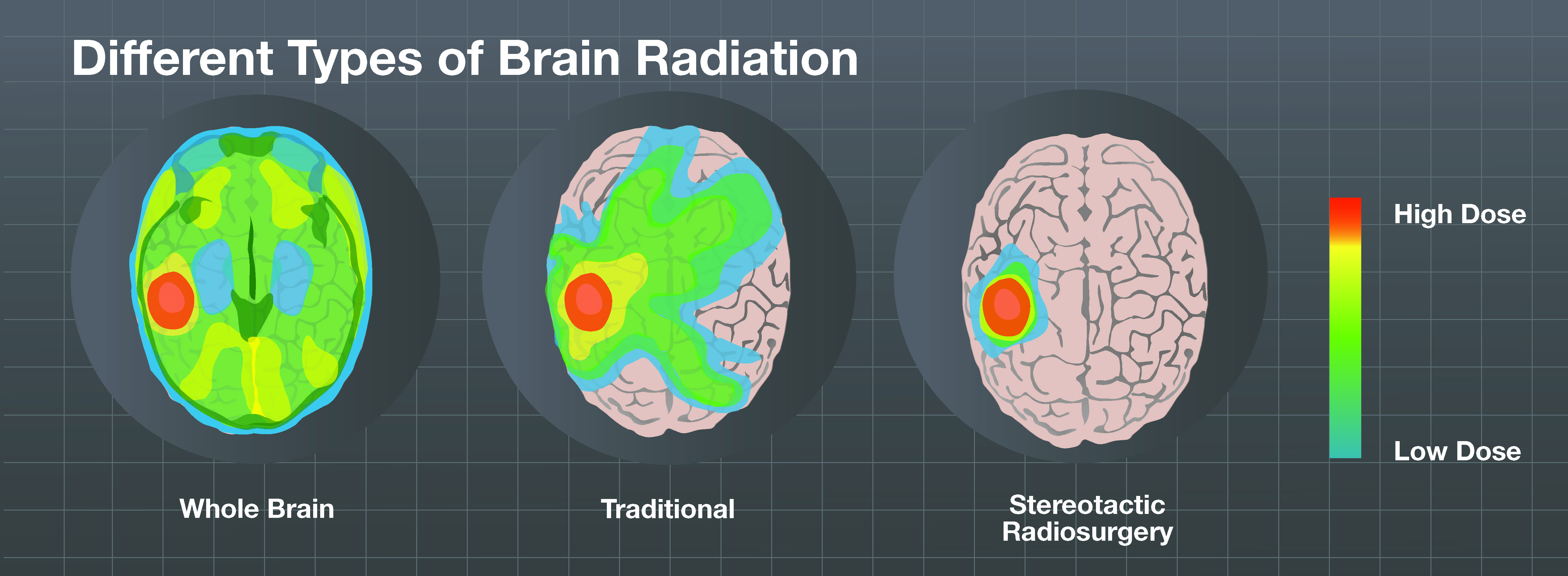 What is Whole Brain Radiation Therapy? 