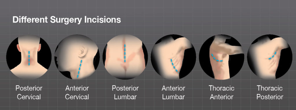 Different Surgery Incisions