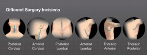 The differents surgical approches for spine surgery